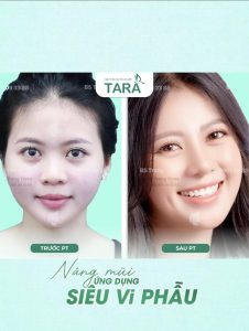 Tại sao cần phẫu thuật nâng mũi siêu vi phẫu chuẩn y khoa
