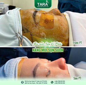 Tại sao cần phẫu thuật nâng mũi siêu vi phẫu chuẩn y khoa