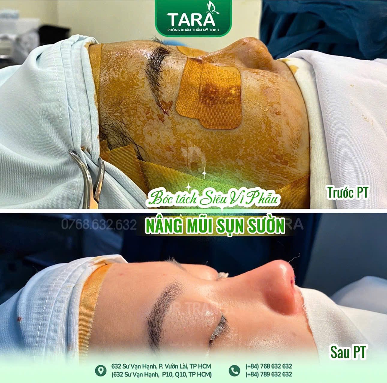 Tại sao cần phẫu thuật nâng mũi siêu vi phẫu chuẩn y khoa