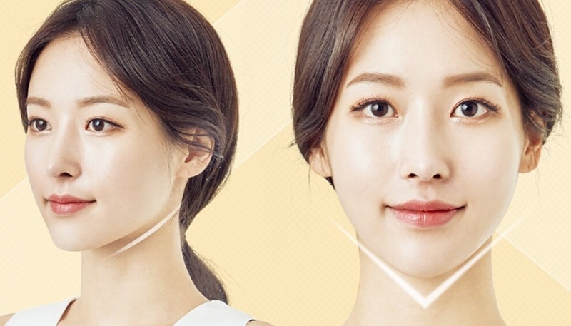 Tiêm tạo hình cằm Vline hay phẫu thuật thì tốt?