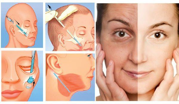 So sánh căng da mặt nội soi-căng da mặt truyền thống