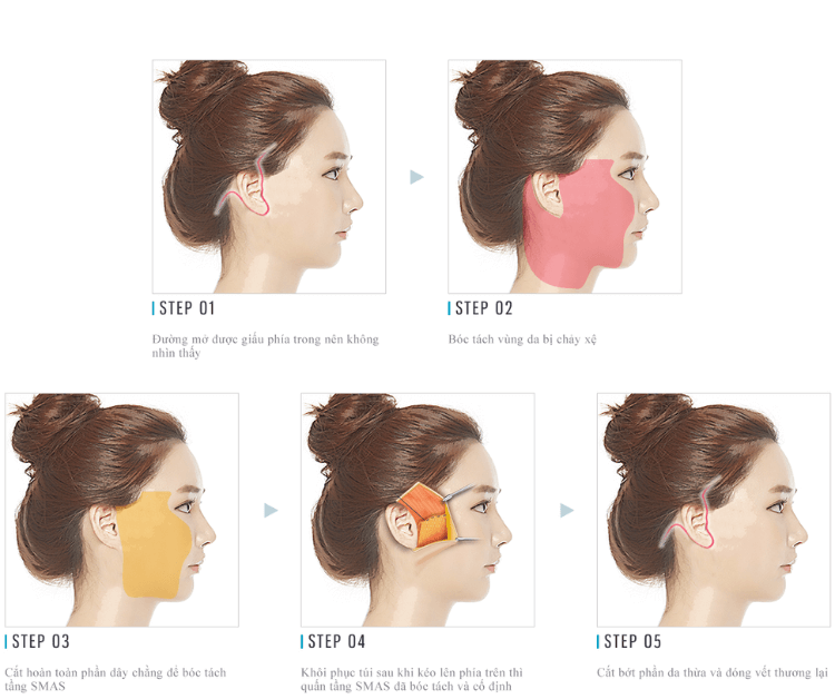 So sánh căng da mặt nội soi và căng da mặt truyền thống