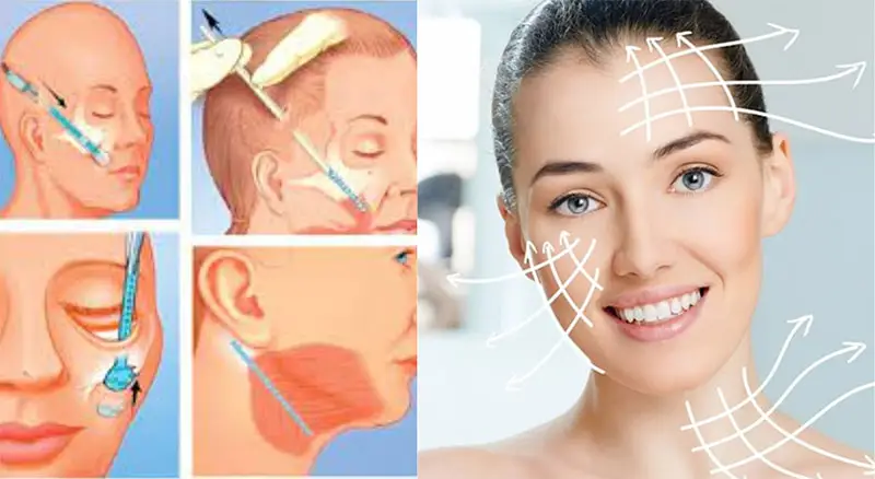 Giải mã kỹ thuật căng da mặt nội soi: Phép màu trẻ hóa an toàn