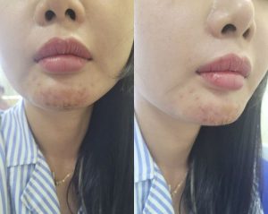 Cách nhận biết filler kém chất lượng, làm sao chọn chỗ tiêm an toàn?