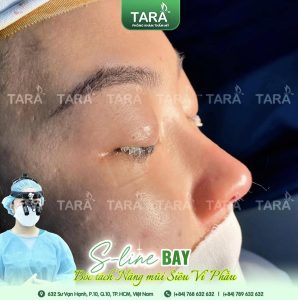 Xem tướng mũi gãy và lỗ mũi bên to bên nhỏ: Nguyên nhân và khắc phục triệt để bằng nâng mũi siêu vi phẫu