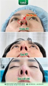 Sửa mũi có đau hơn nâng mũi không và giải pháp "thần kỳ" từ kỹ thuật siêu phẫu