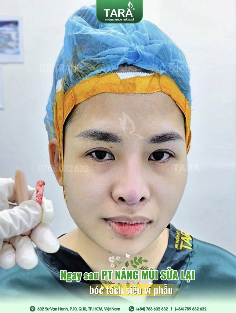 Sửa mũi lần 2, 3 có còn đẹp được không? Tái sinh dáng mũi hỏng bằng kỹ thuật Siêu vi phẫu từ TS.BS Trang TARA