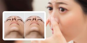 Mũi lệch sau nâng có tự hết không, khi nào cần sửa?