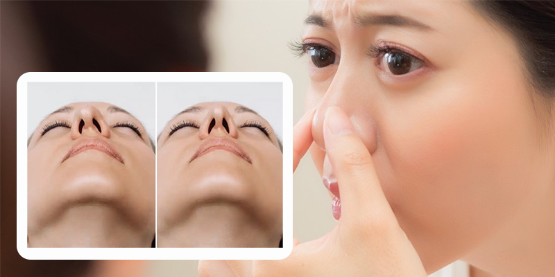 Mũi lệch sau nâng có tự hết không, khi nào cần sửa và giải pháp từ siêu vi phẫu