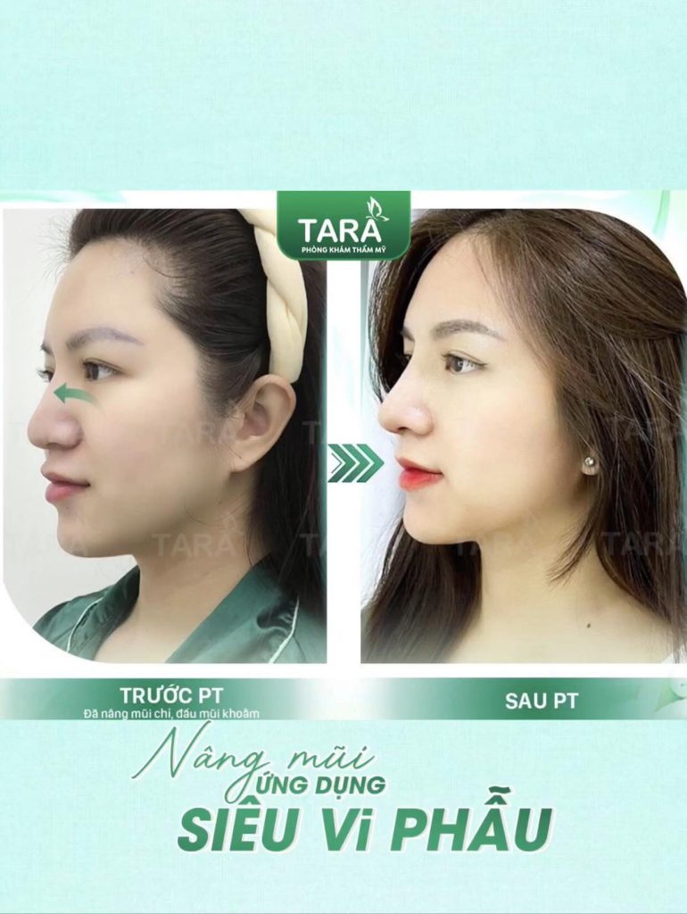 Mũi bị viêm, đỏ đầu mũi có cần tháo sụn nâng mũi gấp không?