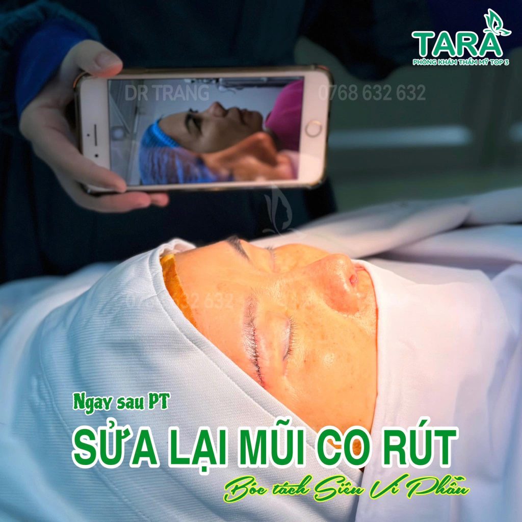 Mũi bị viêm, đỏ đầu mũi có cần tháo sụn nâng mũi gấp không?