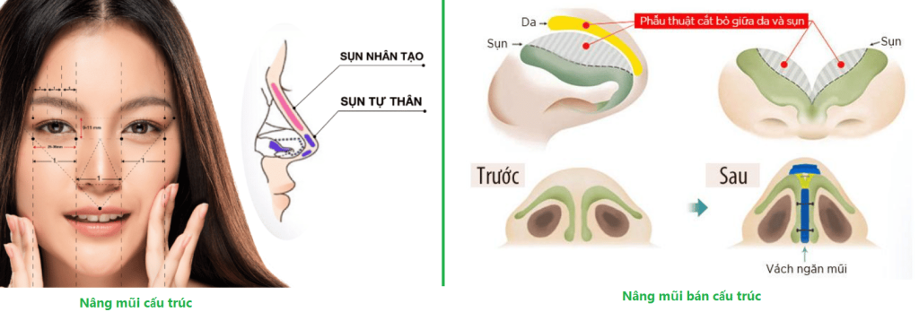 Nâng mũi có ảnh hưởng đến hô hấp, khứu giác không?