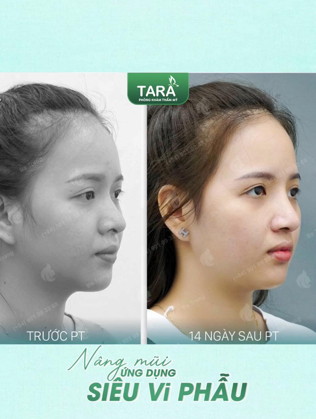 Bác sĩ giải đáp: Nâng mũi có ảnh hưởng đến hô hấp, khứu giác không?