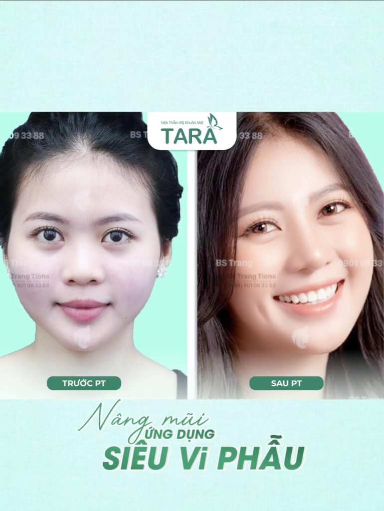 Nâng mũi xong có tháo sụn ra ngay được không?