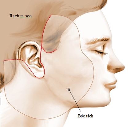 Phẫu thuật căng da mặt: Quy trình, chi phí và thời gian hồi phục