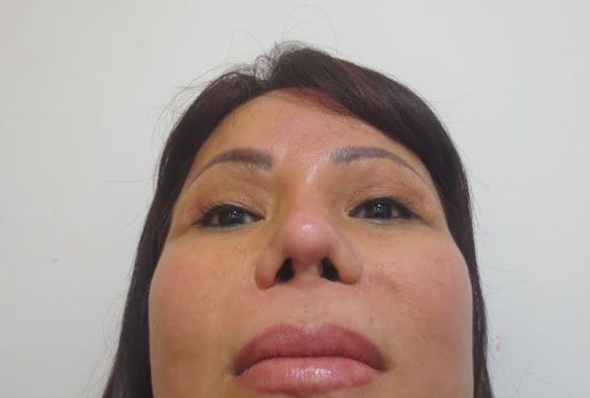 Dấu hiệu mũi sau nâng đang gặp vấn đề cần đi khám ngay