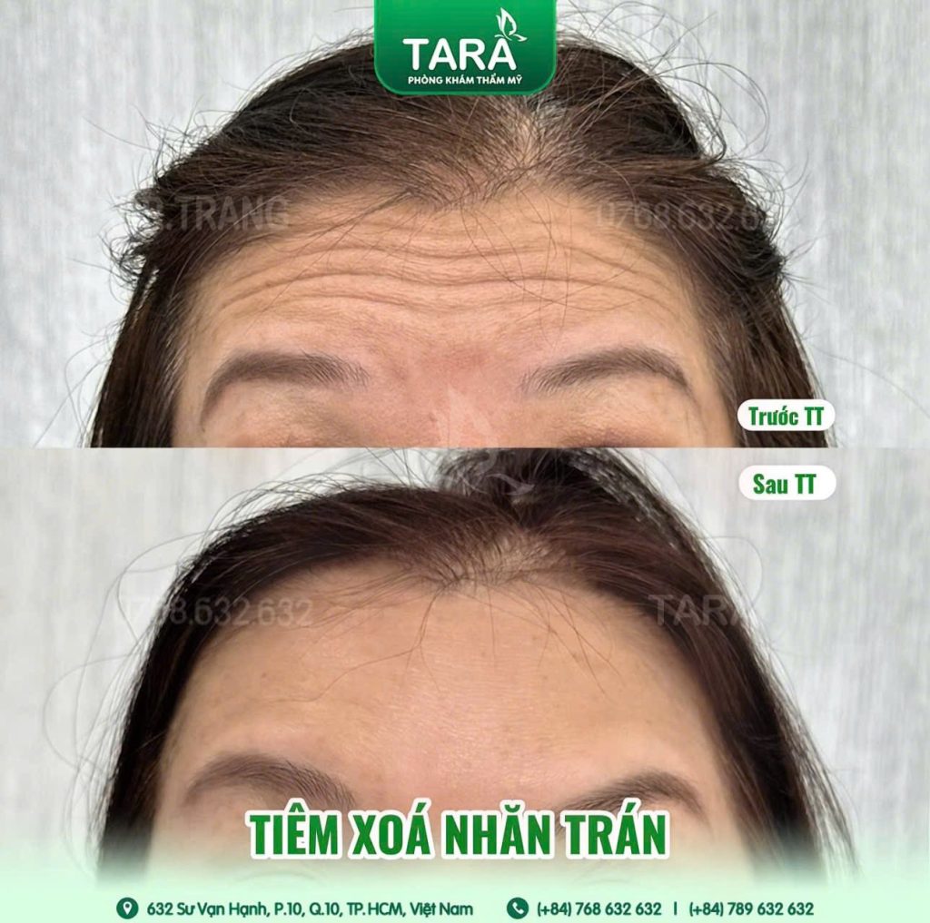 Làm trẻ hóa da mặt tự nhiên, không “đơ”, nên chọn phương pháp nào?