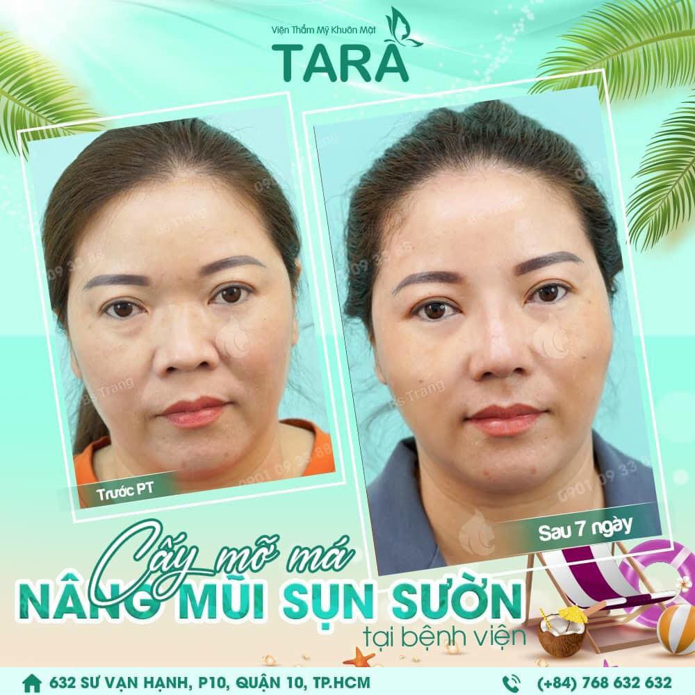 Cấy mỡ mặt trước Tết: nên làm trước bao lâu để không còn sưng?