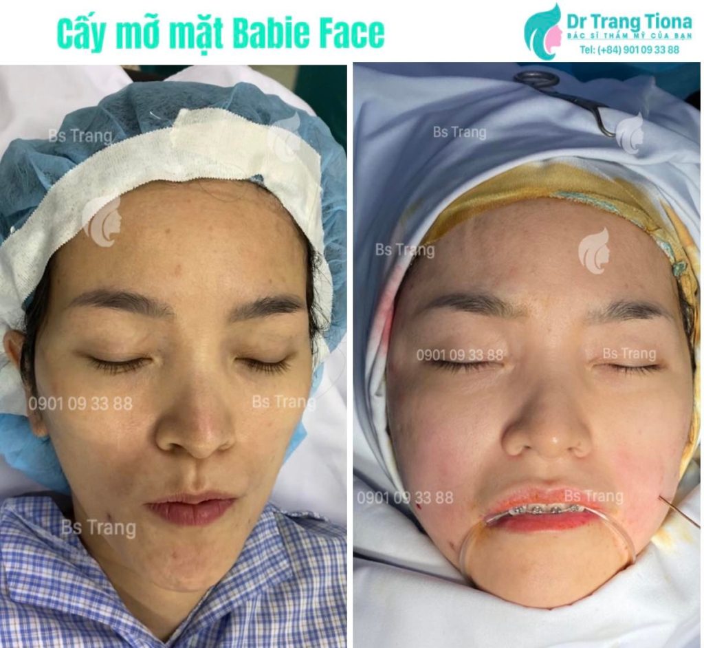 Nên cấy mỡ mặt hay tiêm filler fullface để kịp đẹp trước Tết?