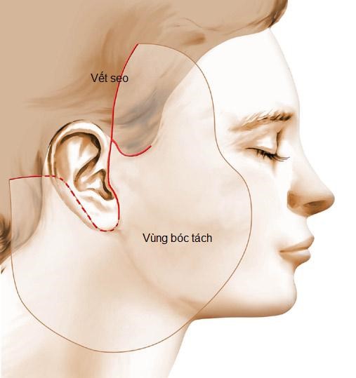 Timeline hồi phục sau phẫu thuật căng da mặt