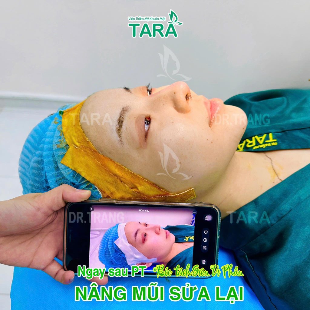 Nâng mũi không nẹp là gì? Khác gì với nâng mũi thông thường?