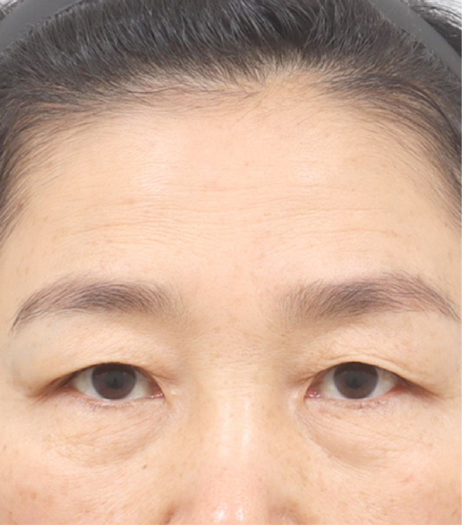 Xoá rãnh lệ hiệu quả từ phẫu thuật dàn đều mỡ dưới mắt 