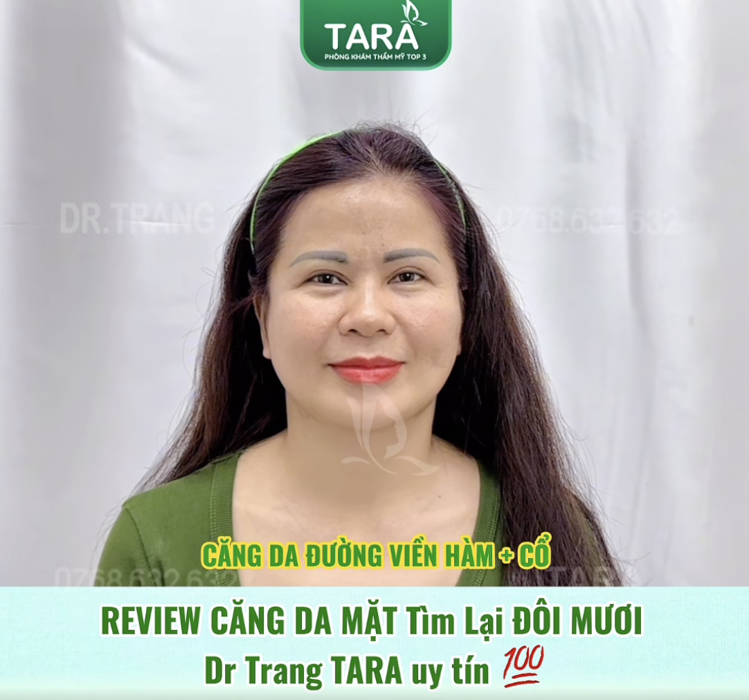 Review căng da mặt tại TARA Beauty TP.HCM: hành trình trẻ lại 10 tuổi của khách hàng