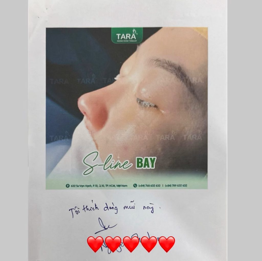 Ai nên nâng mũi không nẹp? 5 nhóm khách phù hợp nhất