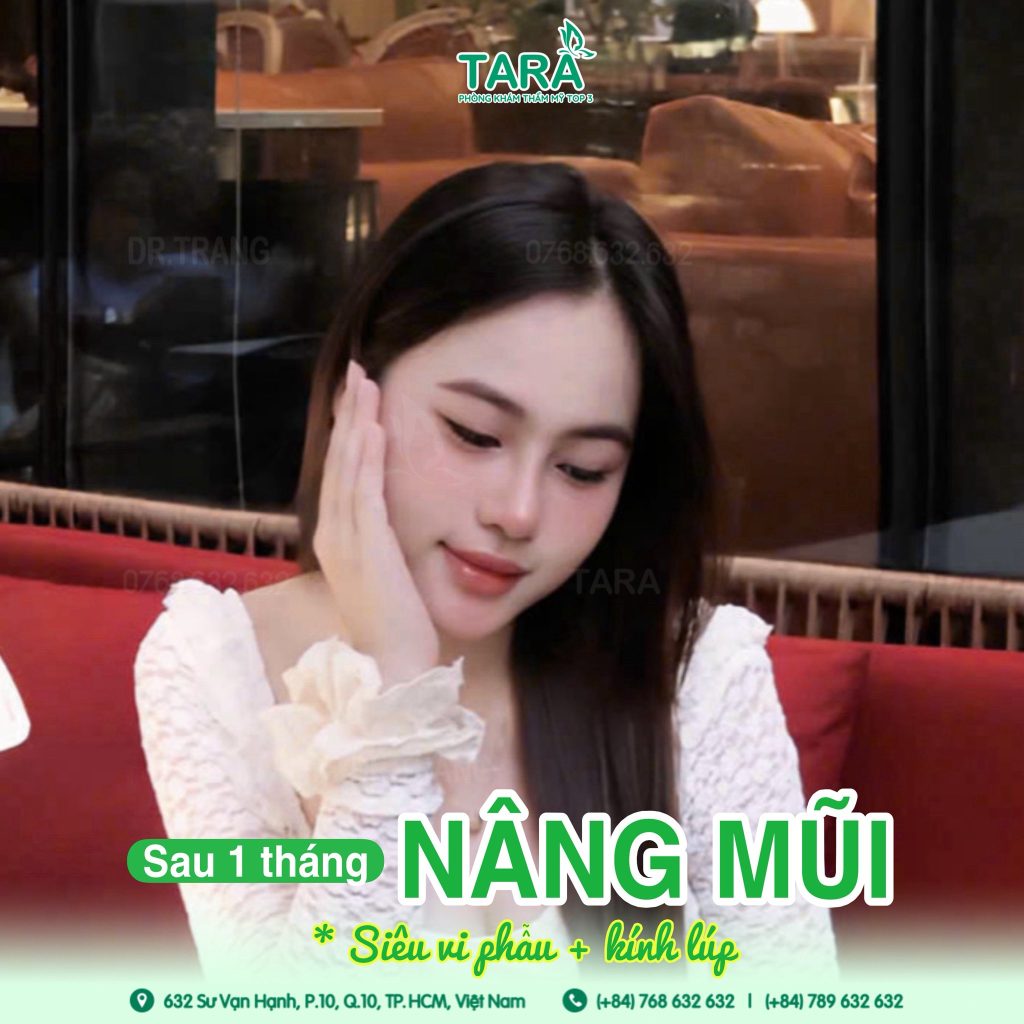 Ai nên nâng mũi không nẹp? 5 nhóm khách phù hợp nhất