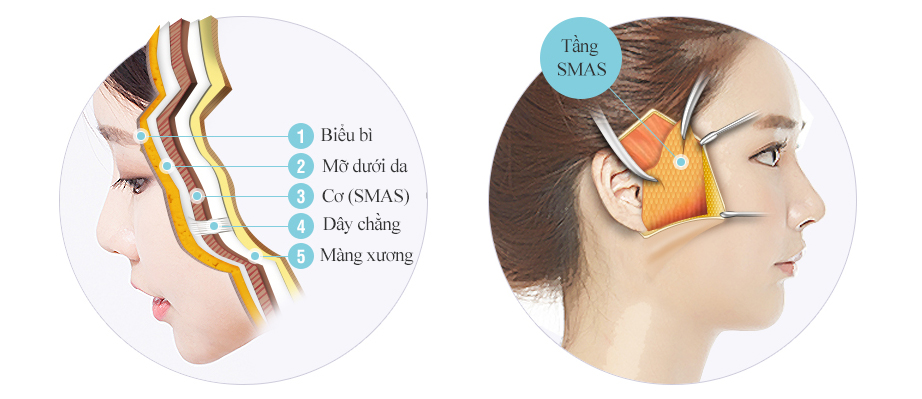 Căng da nâng cơ giữ được bao lâu? Làm sao để hiệu quả lâu dài hơn?