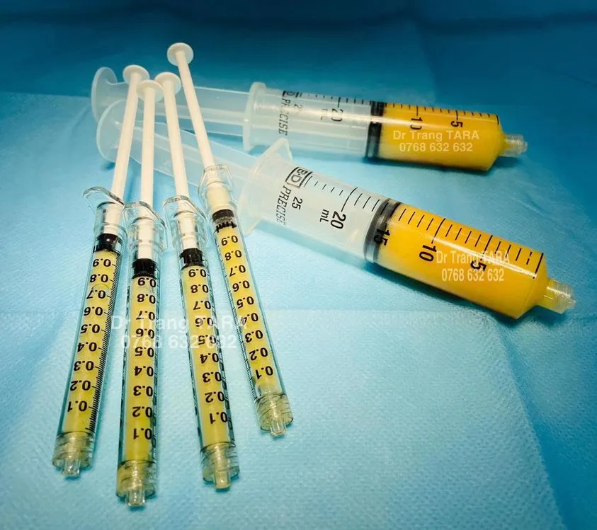 Cấy mỡ má hóp: bí quyết trẻ hóa nửa dưới khuôn mặt