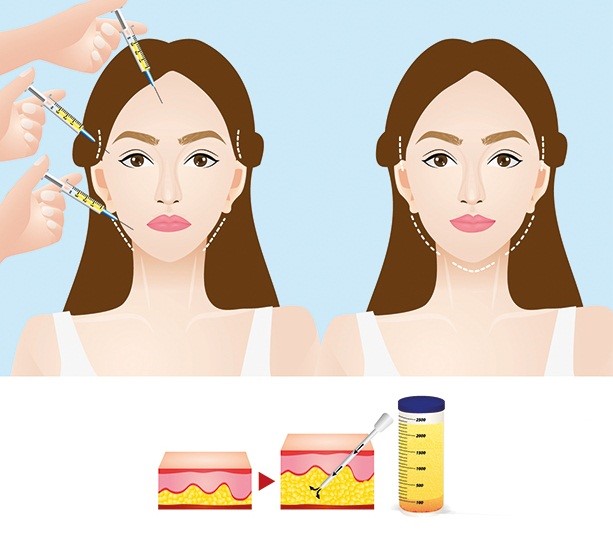 Cấy mỡ má hóp: bí quyết trẻ hóa nửa dưới khuôn mặt