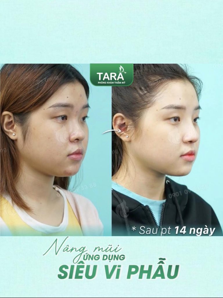 Nâng mũi đẹp tại TP.HCM: bí quyết chọn đúng địa chỉ và gợi ý TARA Beauty