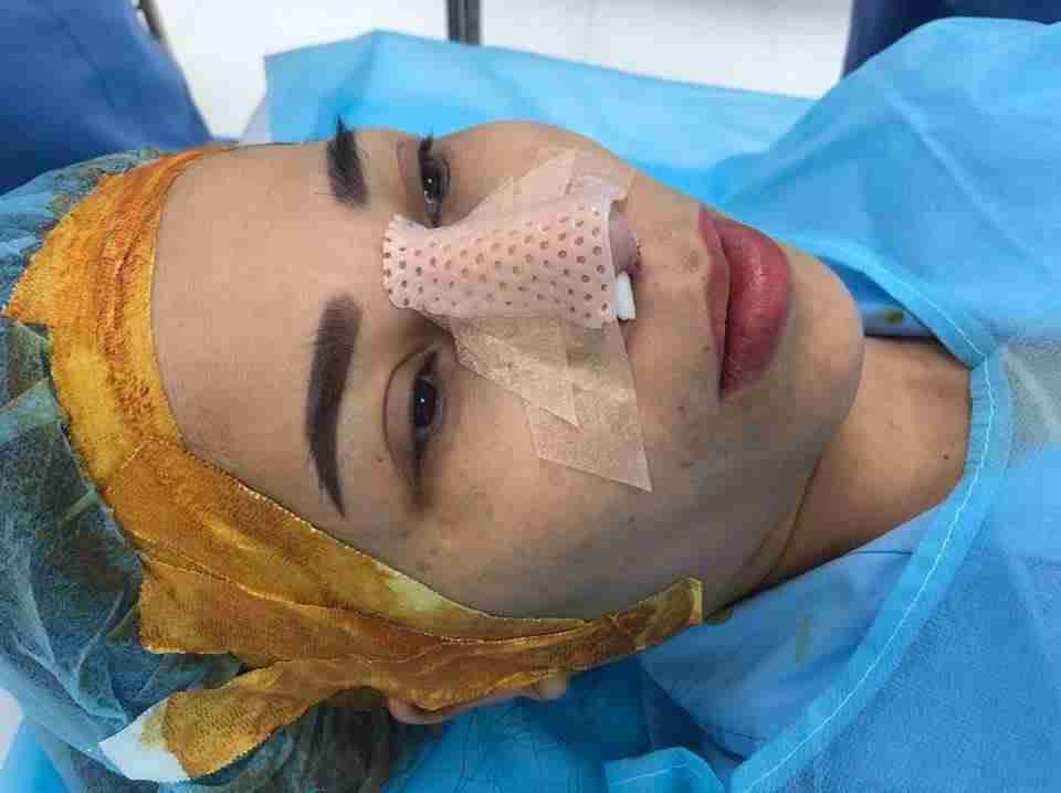 Nâng mũi không nẹp khác gì so với nâng mũi có nẹp? Ưu, nhược điểm từng phương pháp