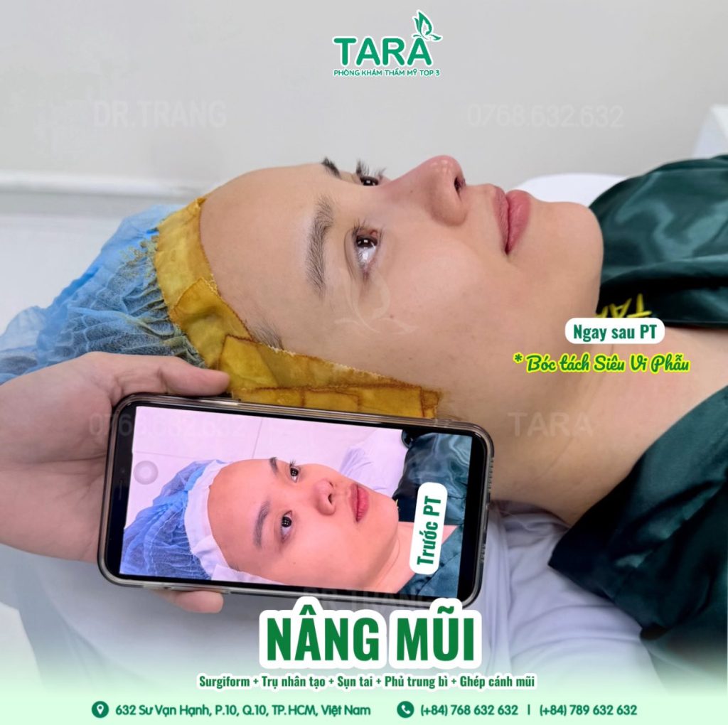 Nâng mũi đẹp tại TP.HCM giá bao nhiêu? Tham khảo bảng giá & lộ trình tại TARA Beauty