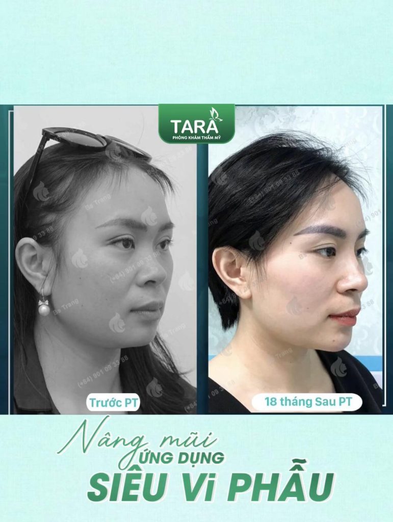 Nâng mũi đẹp tại TP.HCM giá bao nhiêu? Tham khảo bảng giá & lộ trình tại TARA Beauty