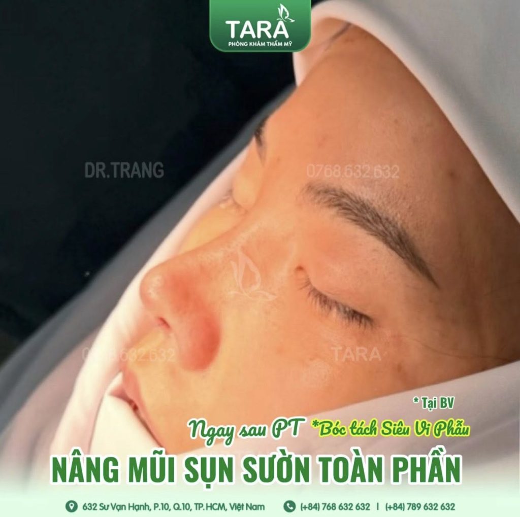 Nâng mũi không nẹp khác gì so với nâng mũi có nẹp? Ưu, nhược điểm từng phương pháp