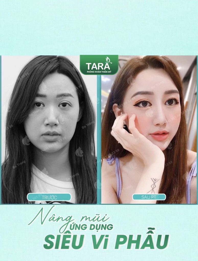 14 câu hỏi thường gặp về nâng mũi không nẹp (giải đáp bởi TS.BS Trang TARA)