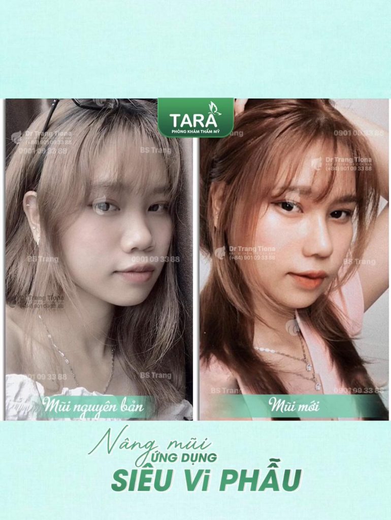 Nâng mũi không nẹp bao lâu thì đẹp? Timeline hồi phục chi tiết 1- 30 ngày