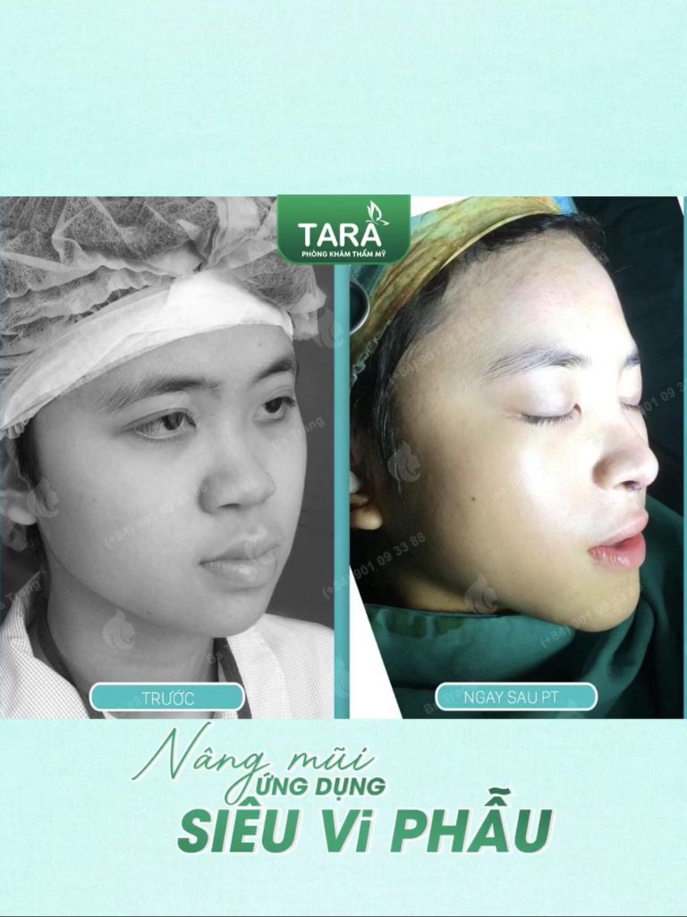 Nâng mũi không nẹp có an toàn không? 7 yếu tố quyết định độ an toàn