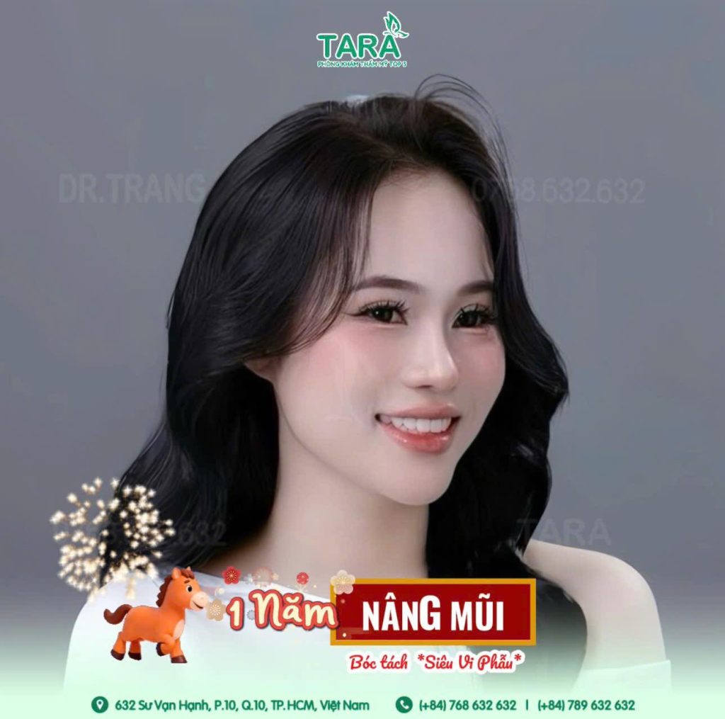 Nâng mũi không nẹp có phải kiêng nhiều không? Khi nào đi làm, makeup, đeo kính lại được?