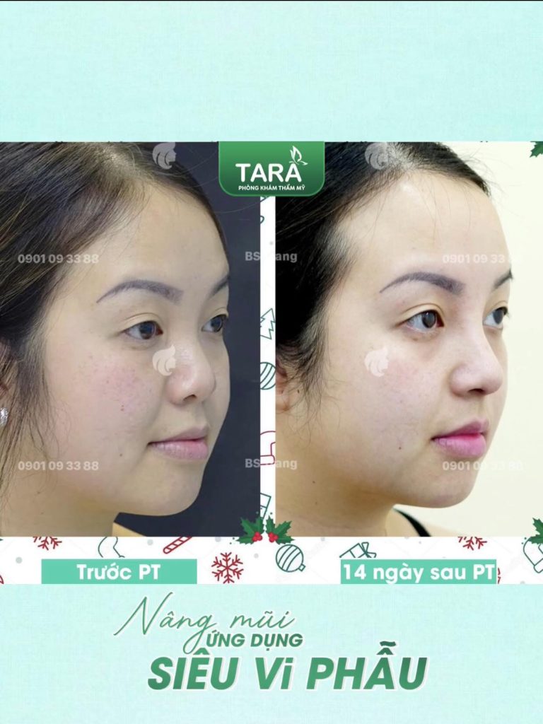 Nâng mũi không nẹp tại TP.HCM: vì sao ngày càng được ưa chuộng?