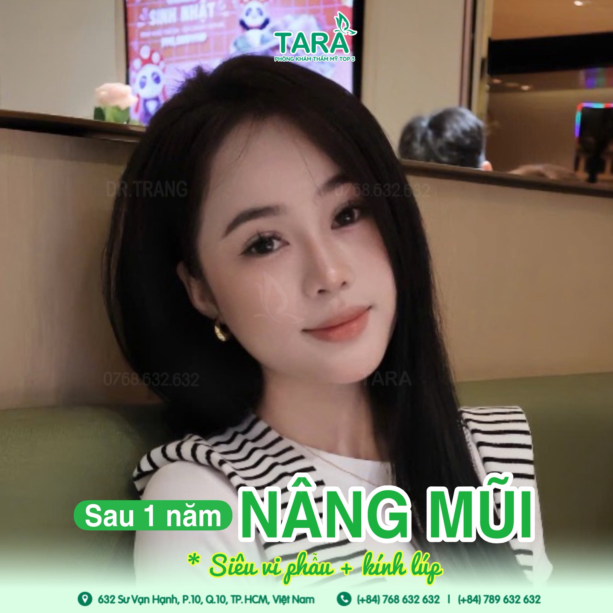 Hành trình thực tế nâng mũi không nẹp tại TARA