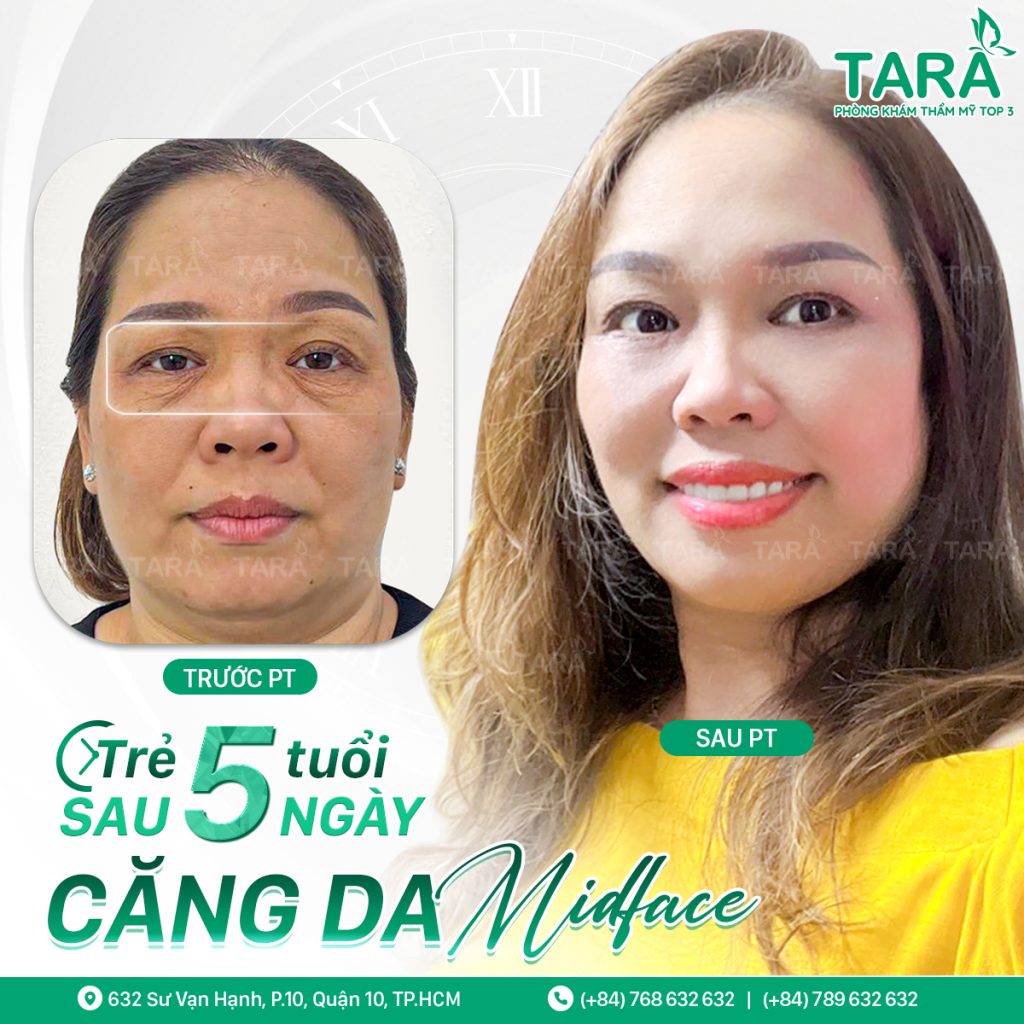 Nên căng da Midface, tiêm filler hay nâng cơ HIFU? Chọn gì cho vùng má giữa bị xệ?