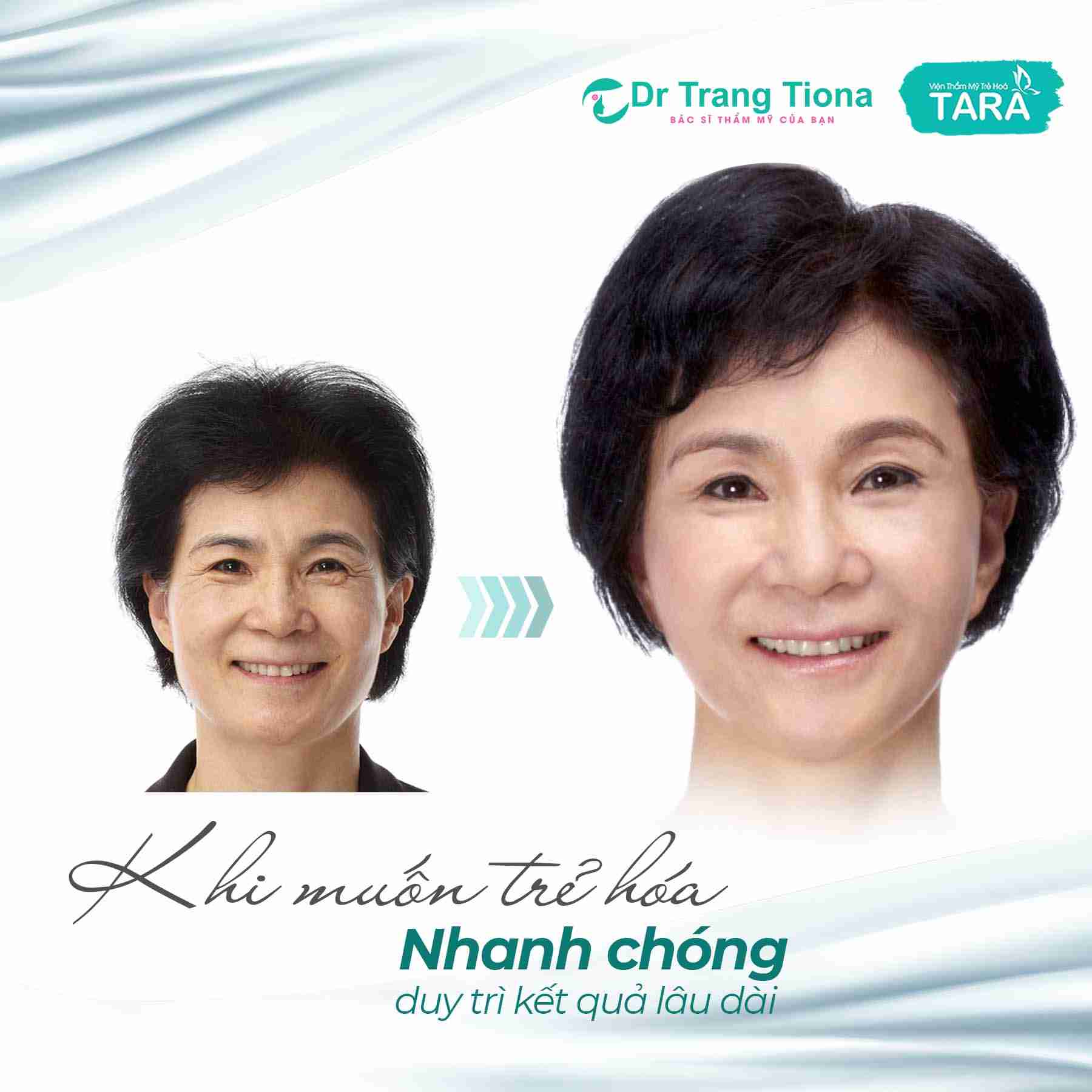 Căng da Midface giữ được bao lâu? Khuôn mặt trẻ ra khoảng bao nhiêu tuổi?