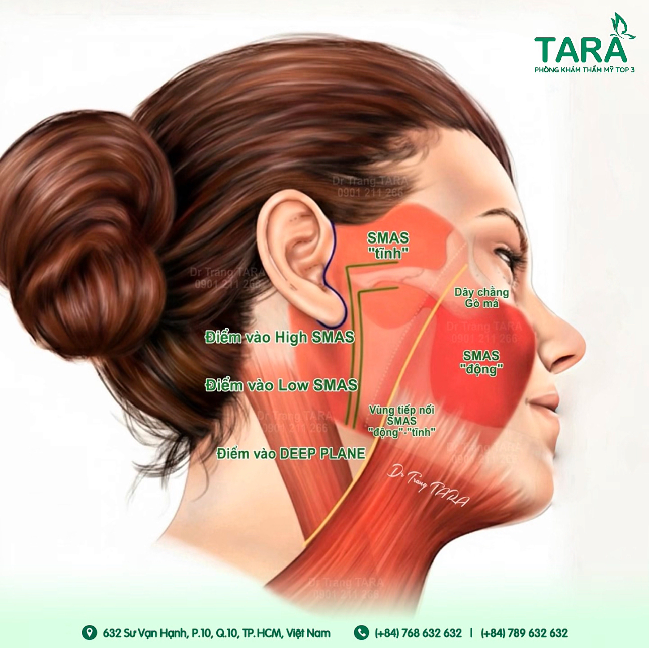 Căng da Midface xử lý rãnh mũi má và má chảy xệ như thế nào?