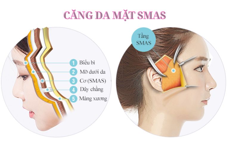 Căng da Midface xử lý rãnh mũi má và má chảy xệ như thế nào?