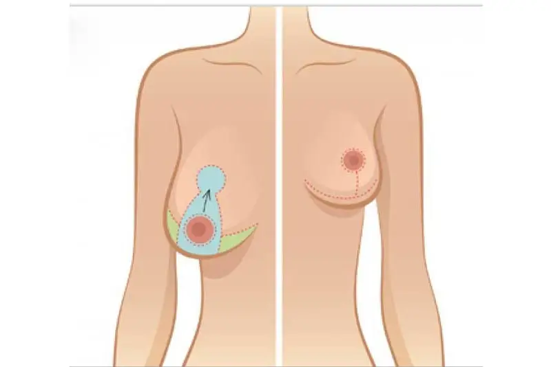 “Nâng vòng 1 nhỏ sau sinh khác gì nâng ngực bình thường? Lưu ý riêng cho mẹ bỉm”