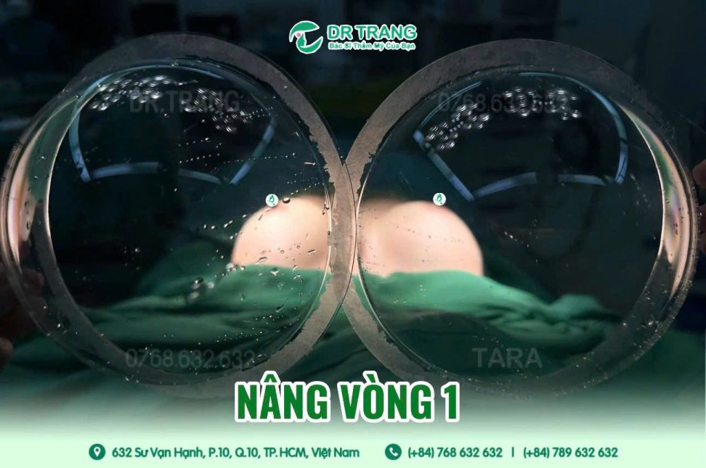 Nâng ngực Omega Preservé là gì? Hành trình lấy lại sự tự tin cho mẹ bỉm