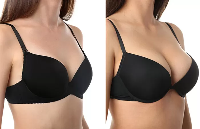 Nâng ngực Omega Preservé có ảnh hưởng đến cho con bú và lần sinh sau không?